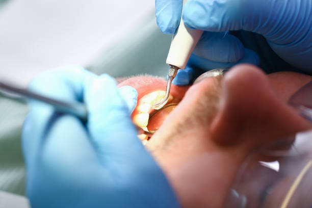 Best Urgent Care for Lost Fillings or Crowns in Oak Park, IL